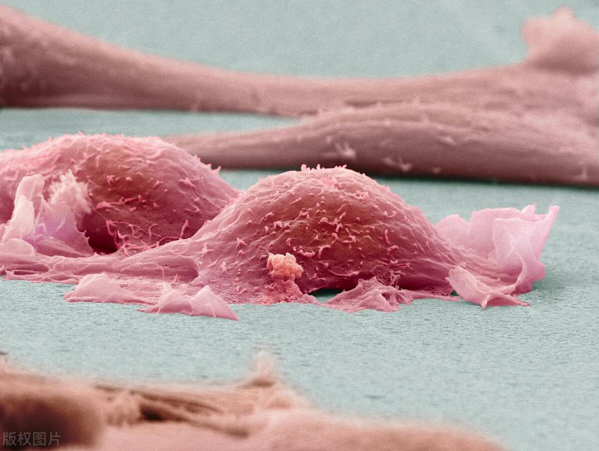 老公肺癌晚期，前天亲吻时，我突然嘴里咸咸的，老公吐痰了？