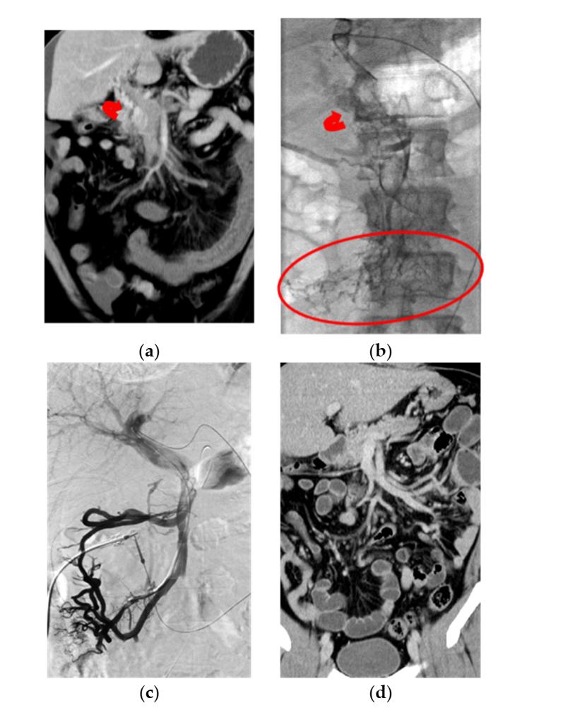 非肝硬化门静脉血栓,门静脉血栓溶栓治疗