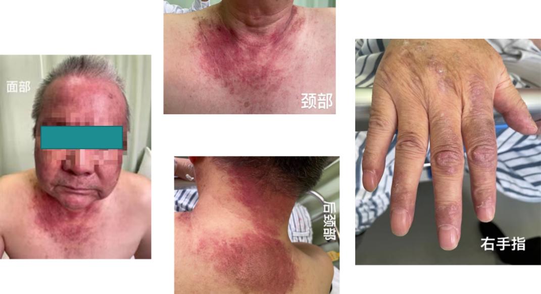 胸口肌肉酸痛皮疹,左肺上叶纵隔旁可见不规则团块影