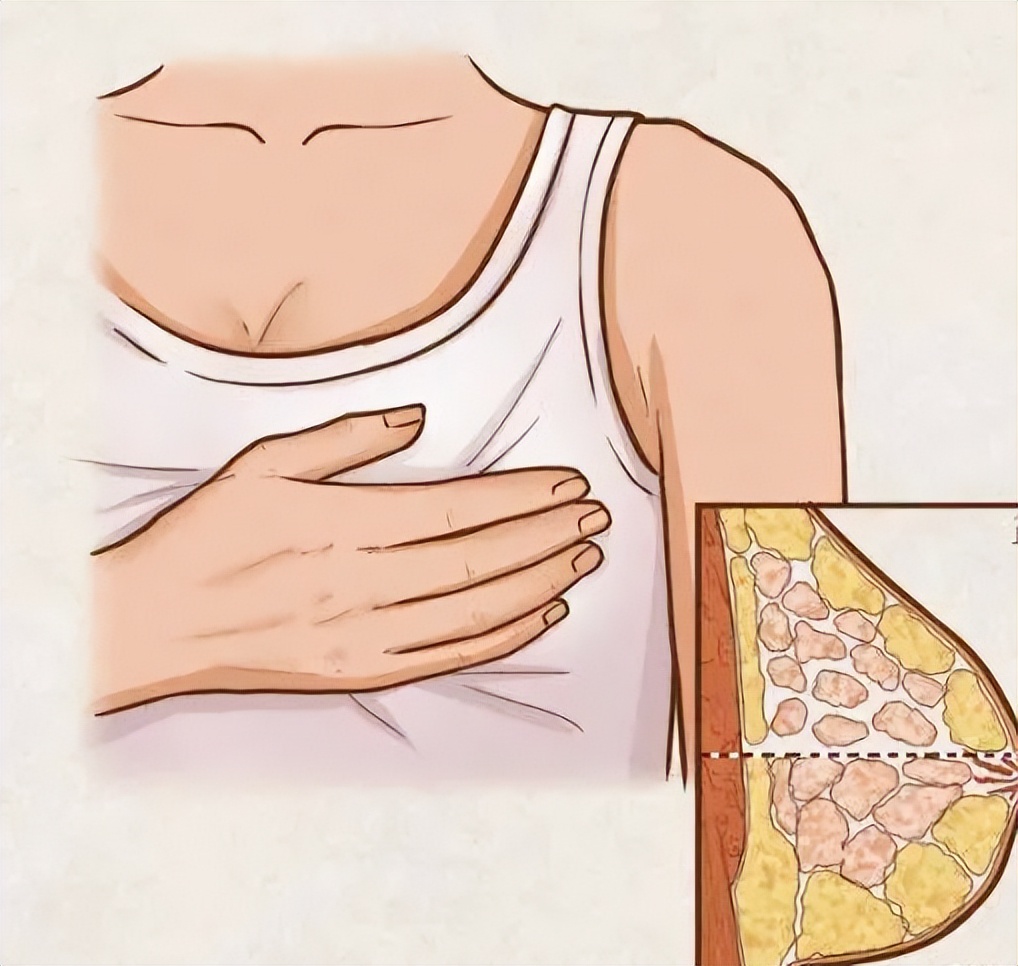 双侧乳腺结节birads3类影响哺乳吗,乳腺结节4a手术切除以后影响哺乳