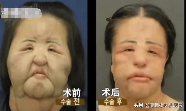 韩慧景整容故事,韩慧景第一次整容