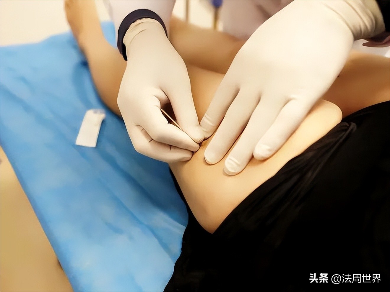 路径还原手法治疗筋膜炎,筋膜炎的拨针疗法