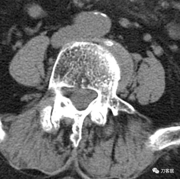 老年人腰骨裂不手术怎么治疗最好,老年腰椎骨质疏松症