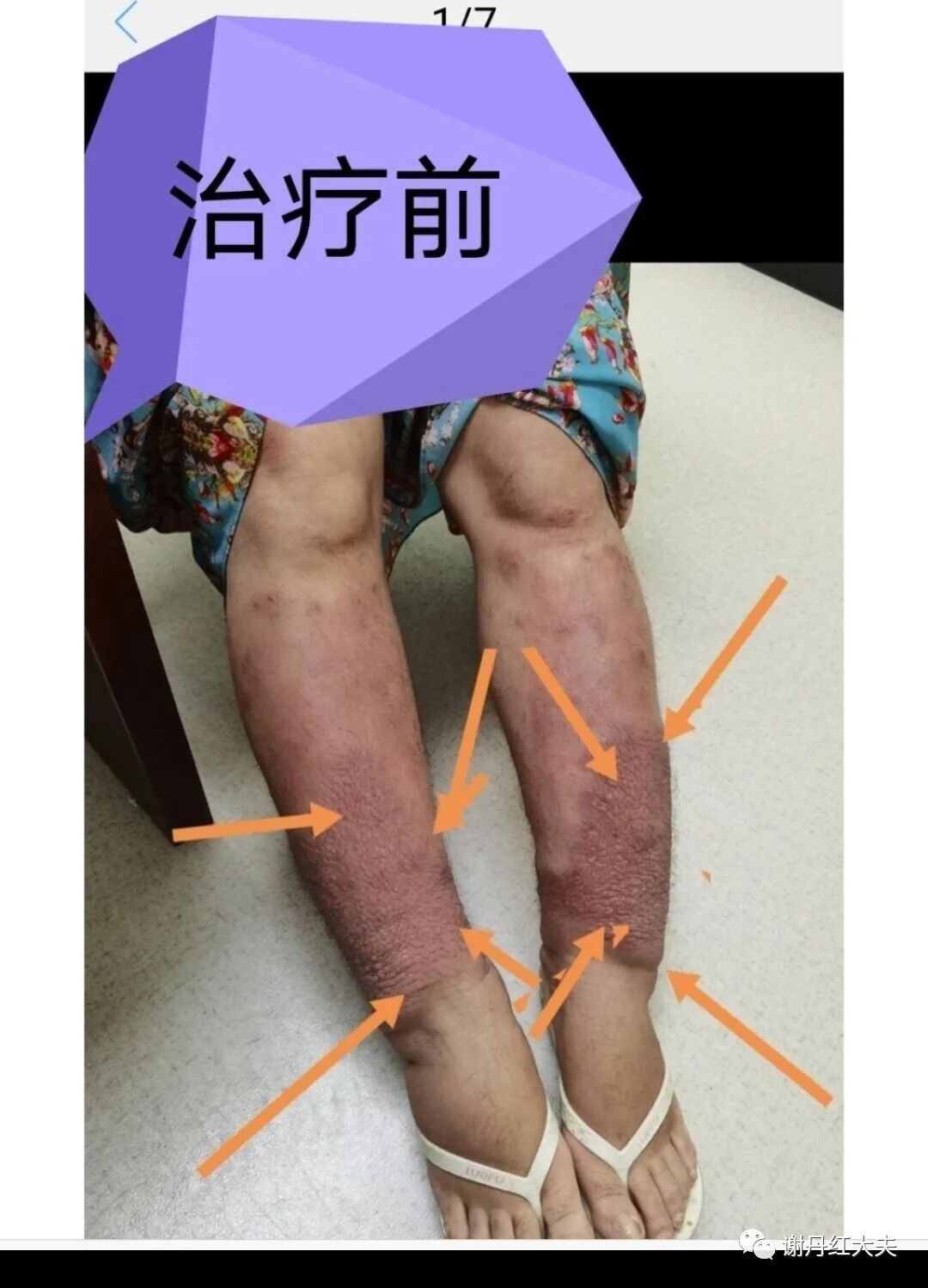 胫前黏液性水肿见于哪些病,胫前黏液性水肿为凹陷性水肿吗