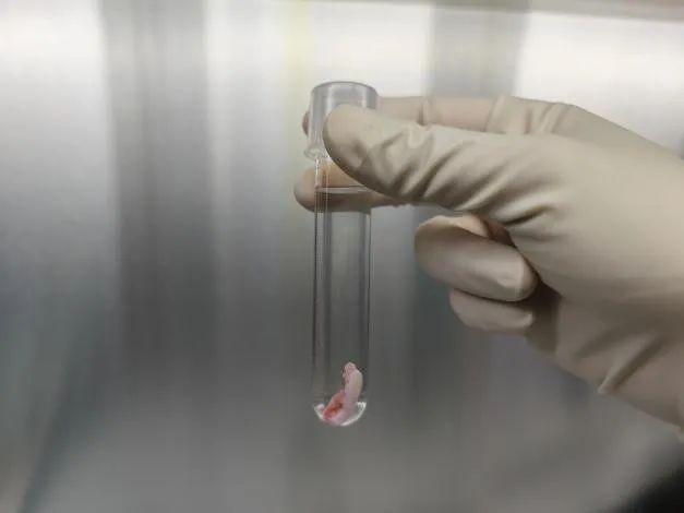 郑大三附院做宫腹腔镜手术,克罗恩肠瘘手术