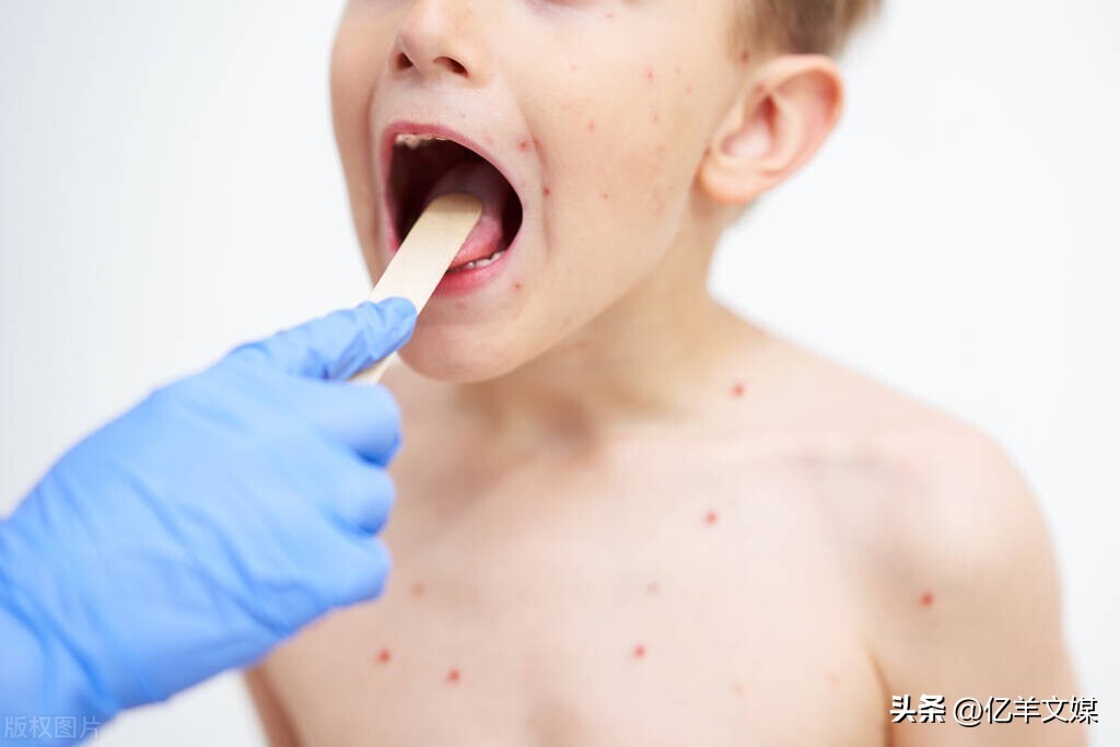 美国报告超4600例猴痘病,专家:欧洲猴痘疫情史无前例