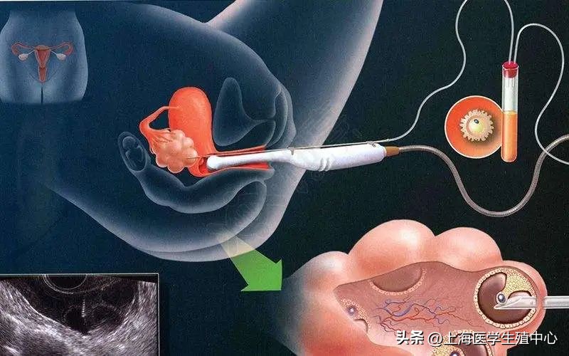 做试管婴儿胎儿会有缺陷吗,试管婴儿空卵泡是怎么回事