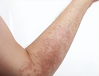 重型再生障碍性贫血69岁能治好吗,再生障碍性贫血的早期症状和前兆