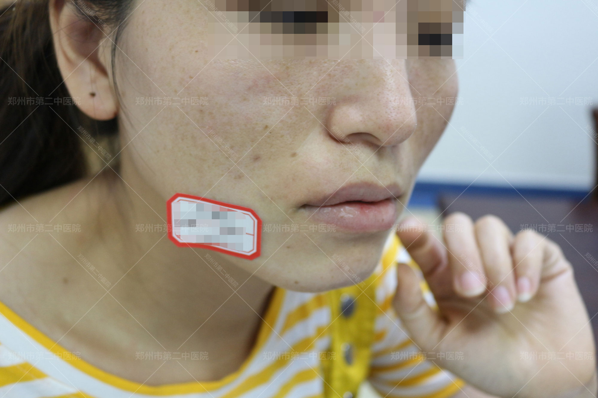 中国治疗凹陷疤痕最权威的医院,郑州第二中医院疤痕修复