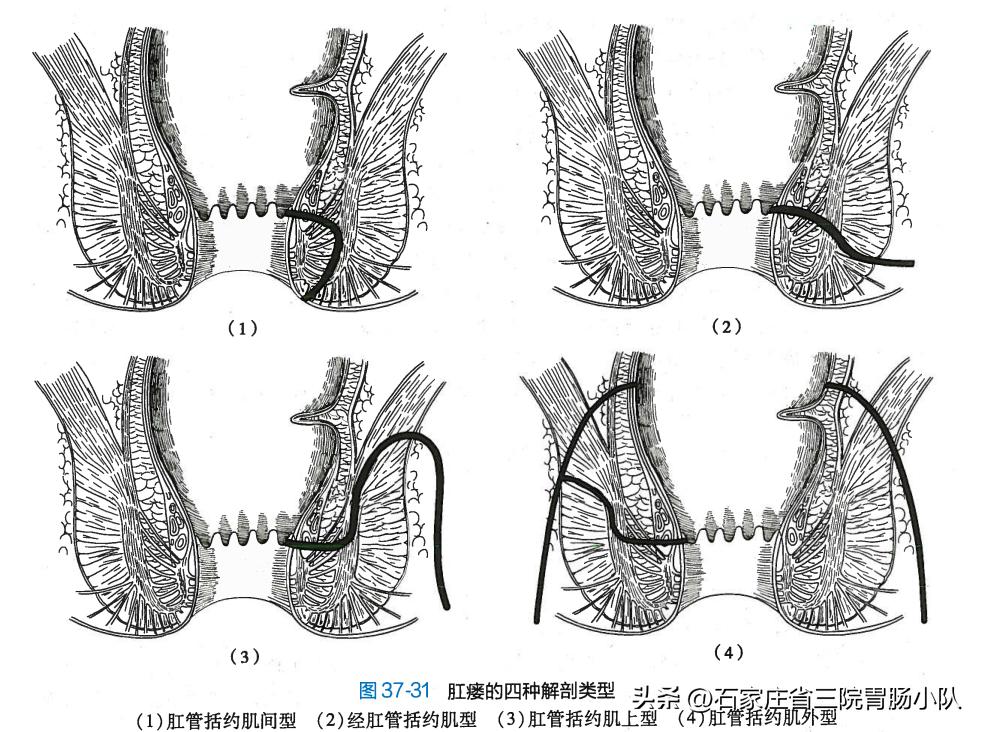 多久发展成复杂肛瘘,复杂肛瘘手术成功率