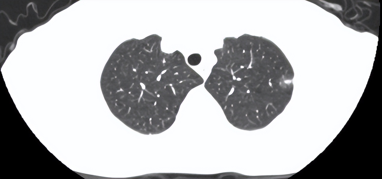 肺结节2x2mm实性结节是癌吗,4毫米结节是肺结节是癌前病变吗