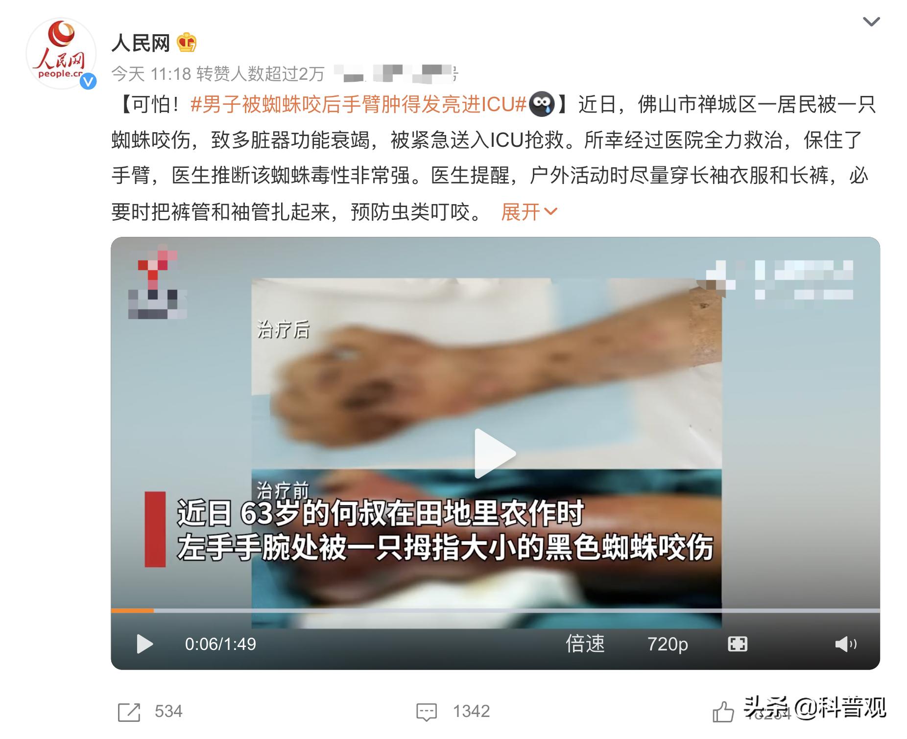 黑寡妇？广东男子被蜘蛛咬伤，手臂肿成两倍粗，一口下去差点丧命