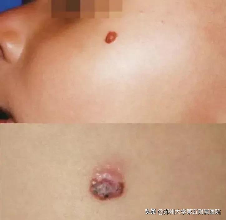 激光祛痣祛得彻底吗,激光祛痣法真的有用吗