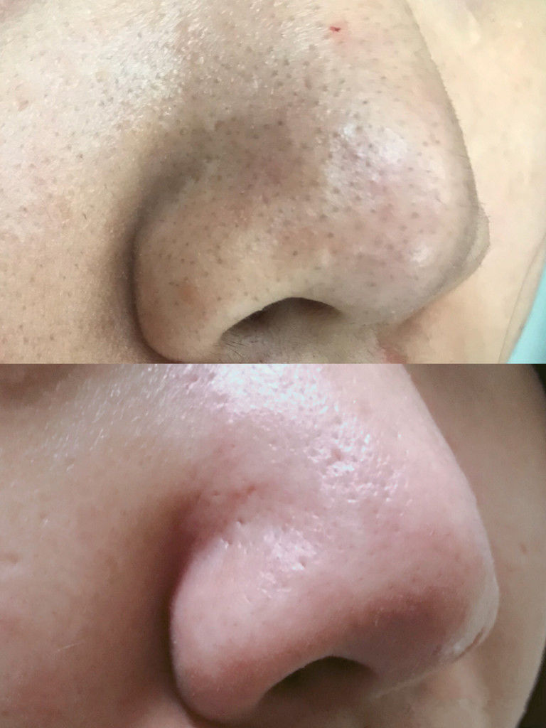 为什么鼻子可以挤出很大的黑头,用夹子挤出鼻子黑头