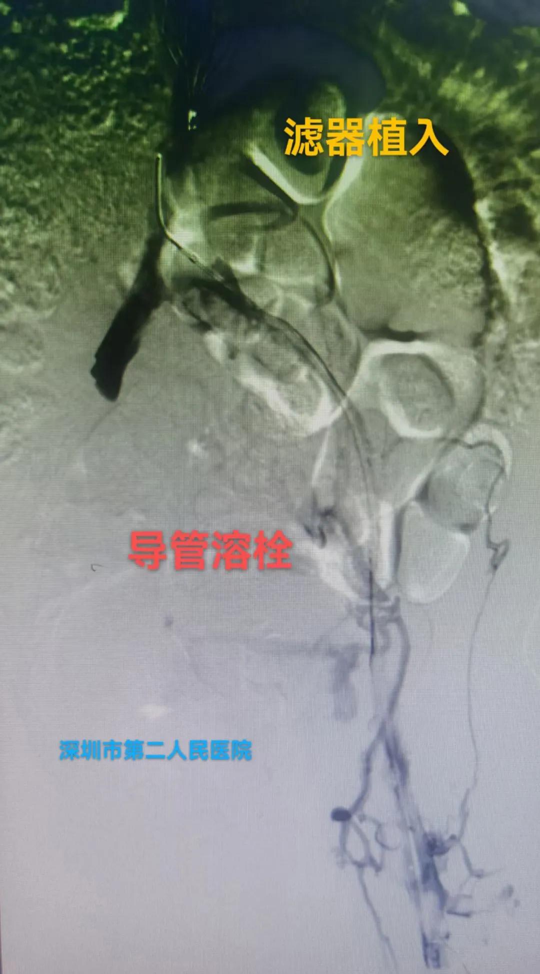 病人腿肿如何消除,病人腿肿了怎么回事