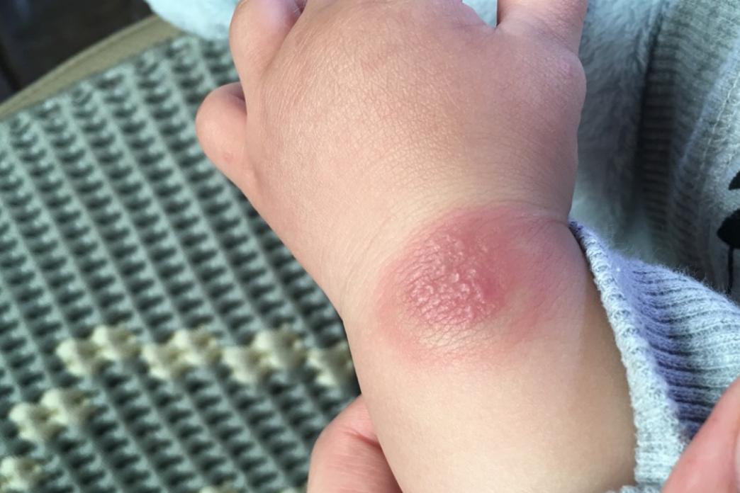 夏天如何预防幼童被蚊子叮咬,宝宝夏季被蚊子咬了怎么消除