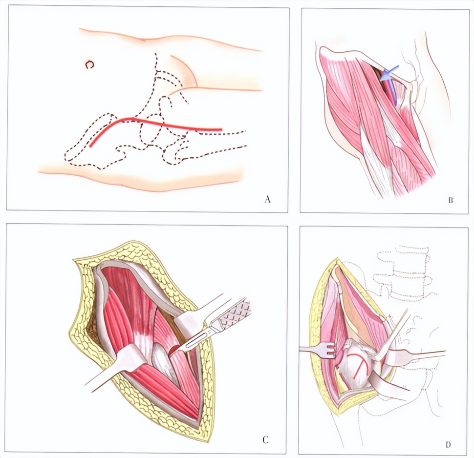 老人股骨头骨折手术,股骨头骨折最佳手术方法