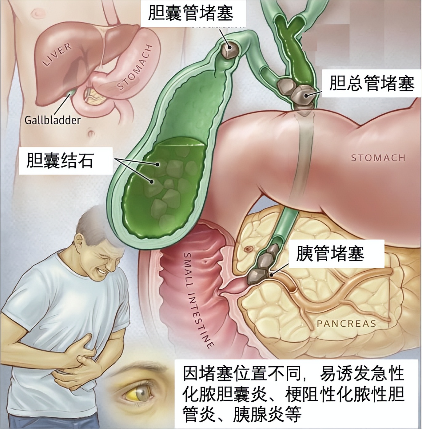 “一根细针”解除九旬病患的病痛！泗泾医院为高龄老人完成经皮经肝胆囊穿刺置管引流手术