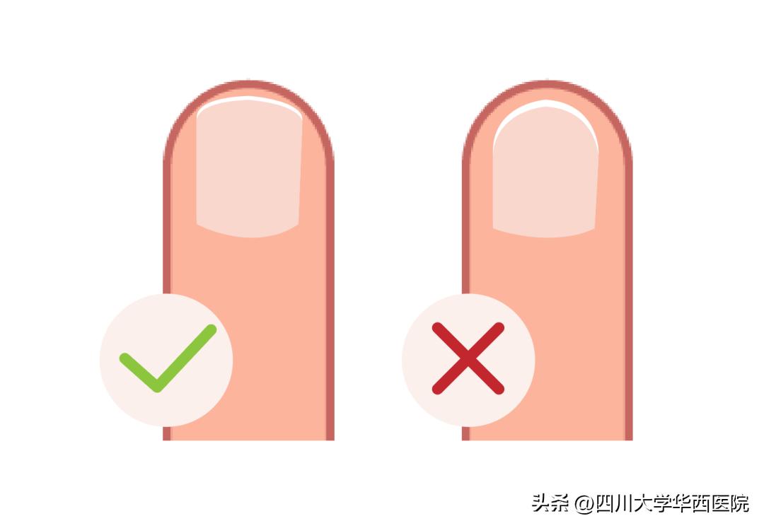 华西专家说，不是转你们，起码有一半的人从没有剪对过指甲儿！