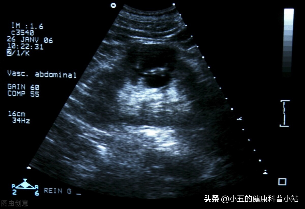 肾囊肿是什么样的病有什么危害,肾囊肿是肿瘤吗有什么危害