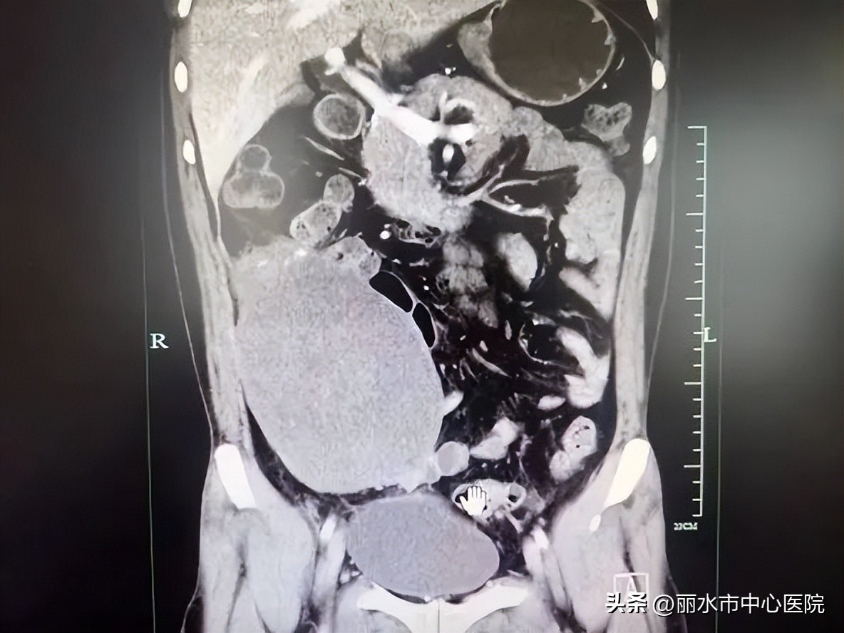 多学科合作治愈腹腔巨大肿瘤