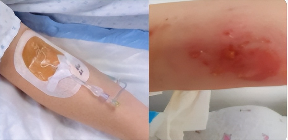 癌症病人输液港是什么,输液港对癌症有什么危害