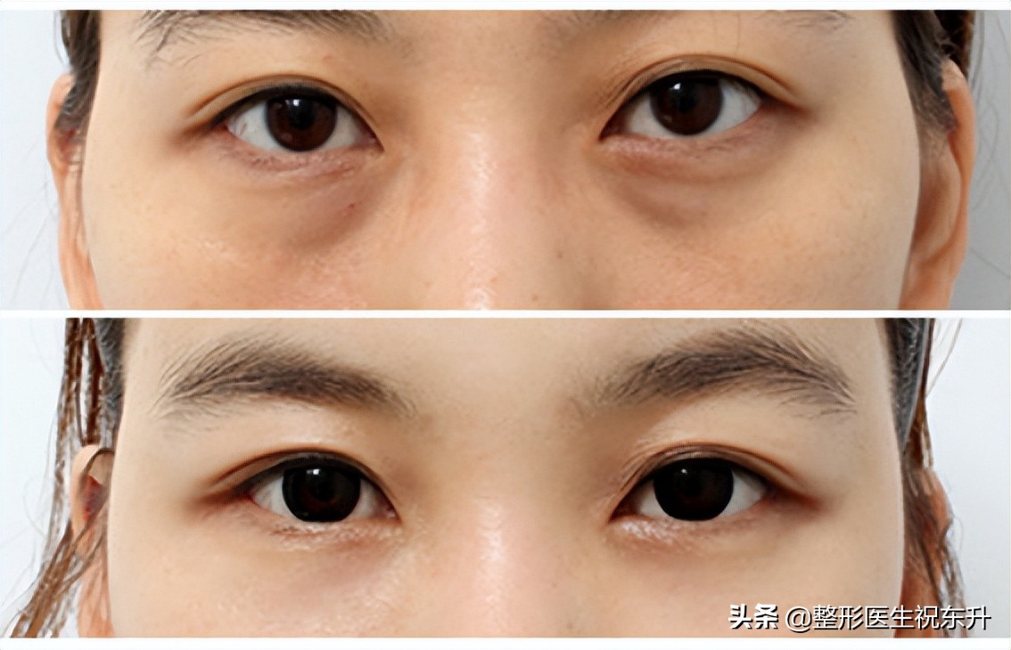 做眼袋外切手术真实经历,做眼袋手术大概需要多少钱安全吗