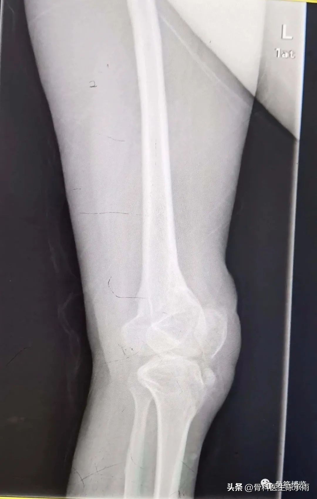 股骨颈闭合复位内固定术后护理,股骨颈骨折闭合复位的技巧