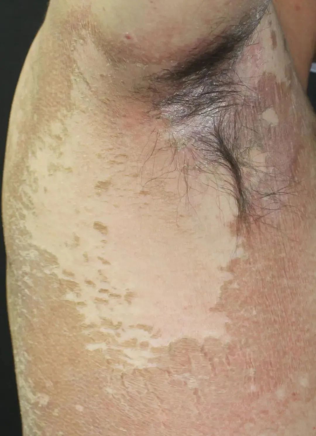 洗衣用消毒液出现皮肤不适,消毒液对皮肤瘙痒有作用吗