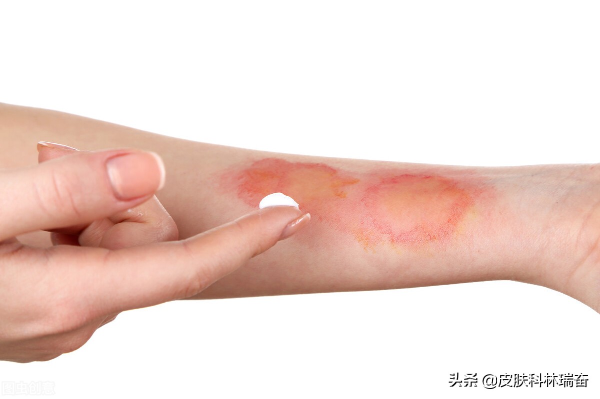 目前治疗疤痕最省钱的三种方法,疤痕消除手术有几种