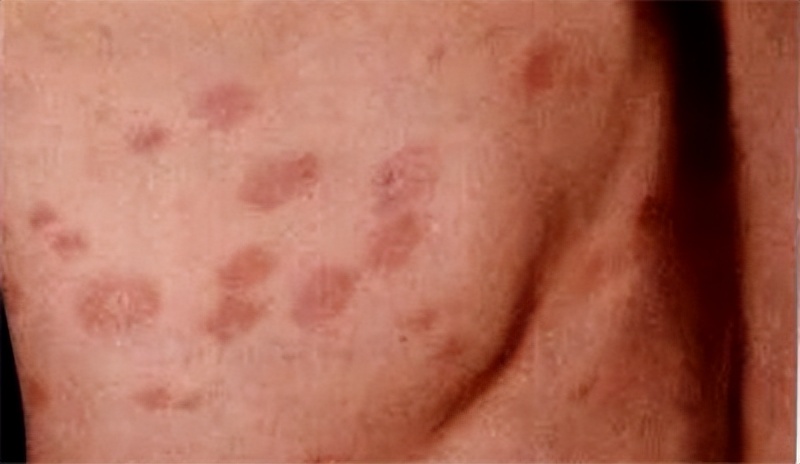 盛开在皮肤上的花朵,玫瑰糠疹花型