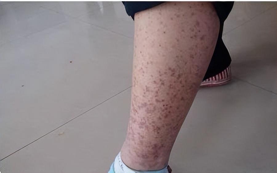 紫癜初期小血点图片,过敏性紫癜中药好还是西药好