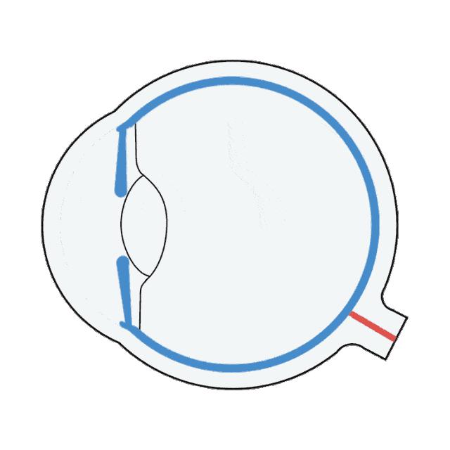 角膜白斑能做近视晶体植入吗,角膜薄近视手术晶体植入