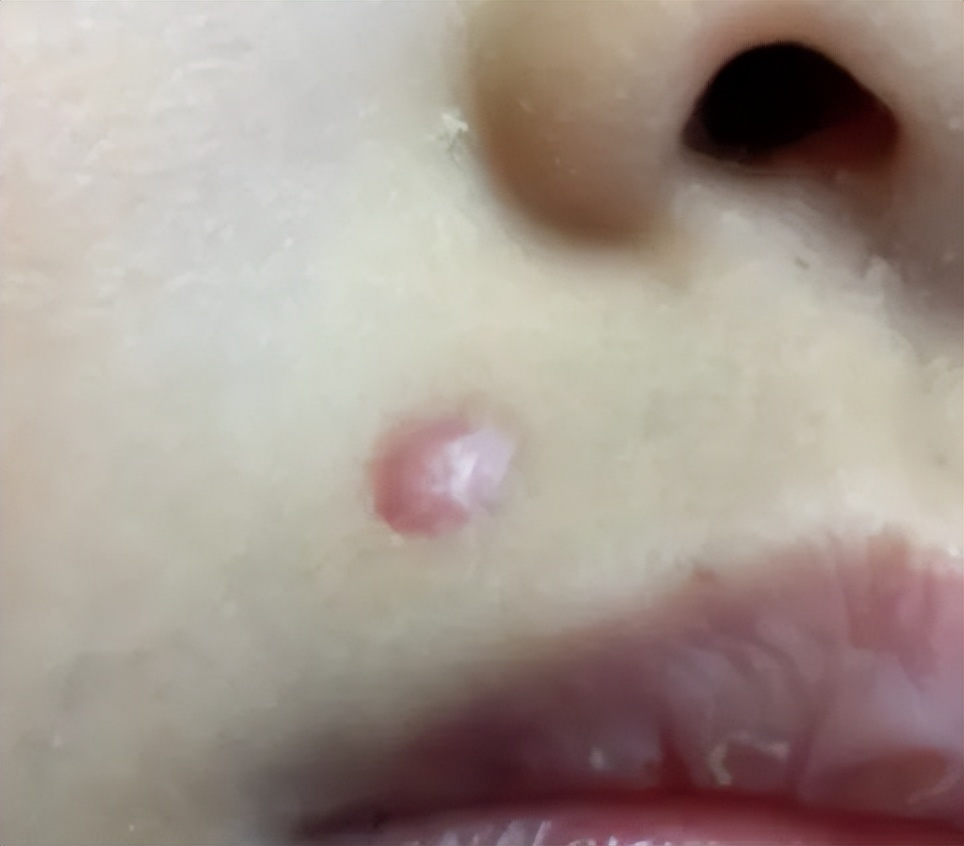 点痣水点痣留疤痕怎么办,如何修复点痣后的凸起疤痕