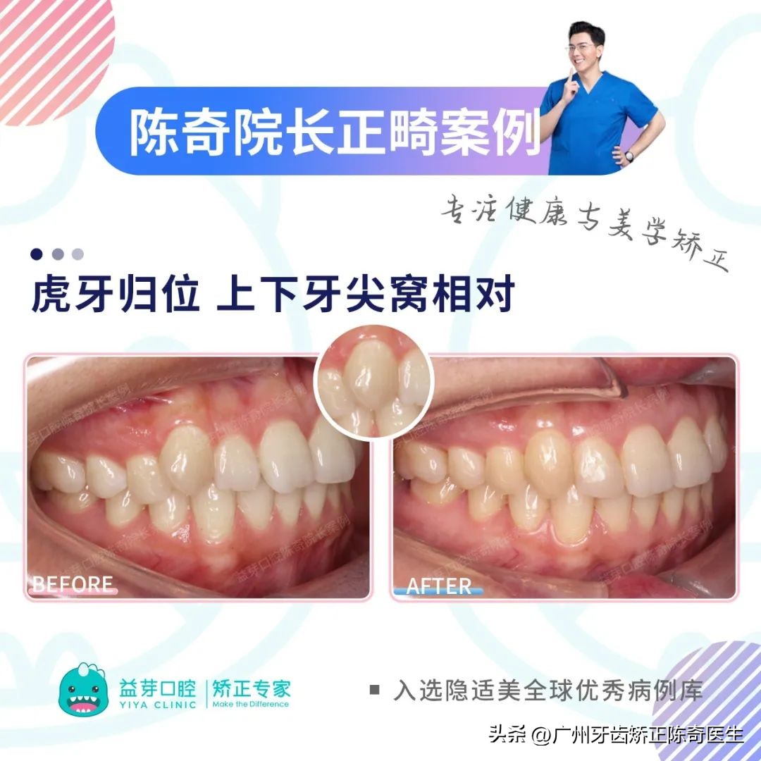 正畸治疗的基本矫治方法,正畸修复联合案例