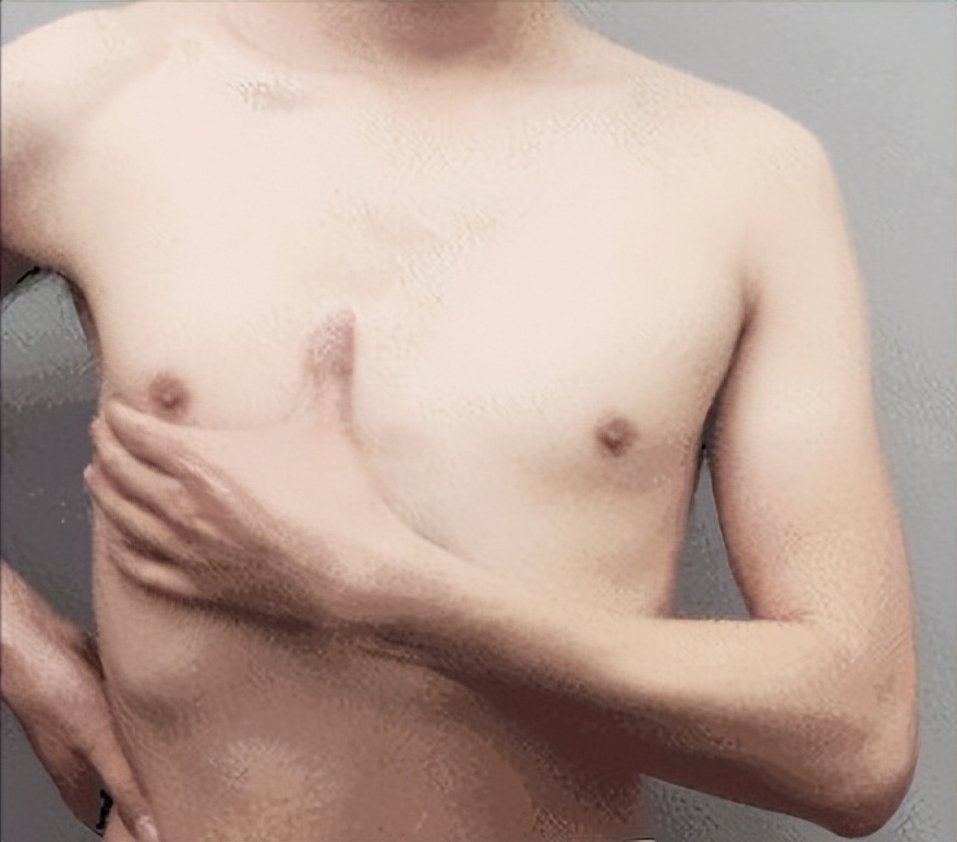 为什么男生的胸部很大,男生胸部大怎么办