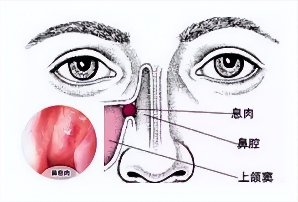 鼻塞总是呼吸不上来要窒息,鼻塞老是感觉吸气不够