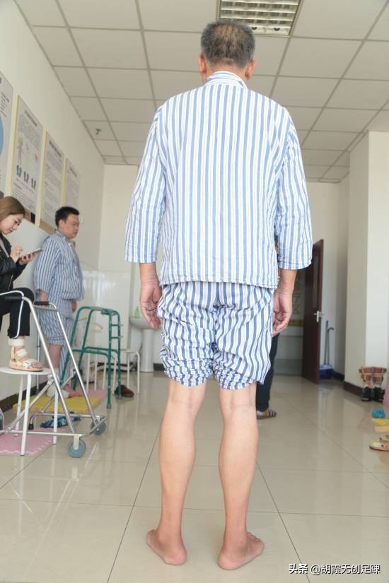 马蹄足内翻矫正有没有后遗症,30岁严重的马蹄内翻足矫正