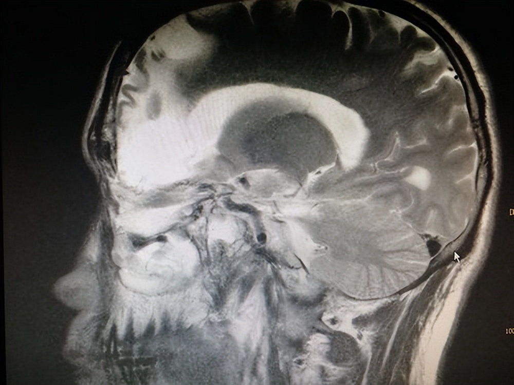 鼻内翻性乳头状瘤的术式选择和疗效分析