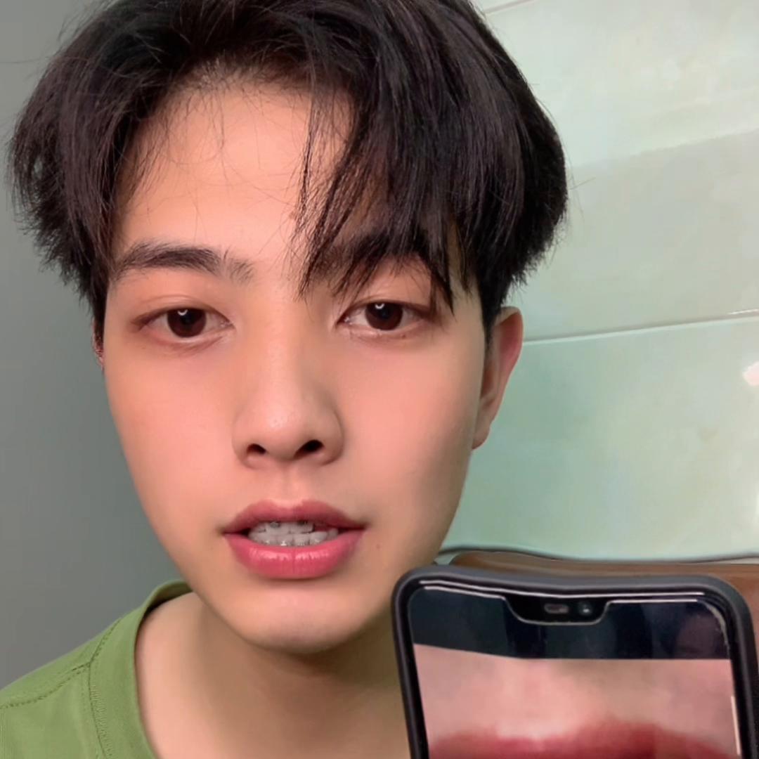 牙套怎么固定在牙上的,牙套矫正过程