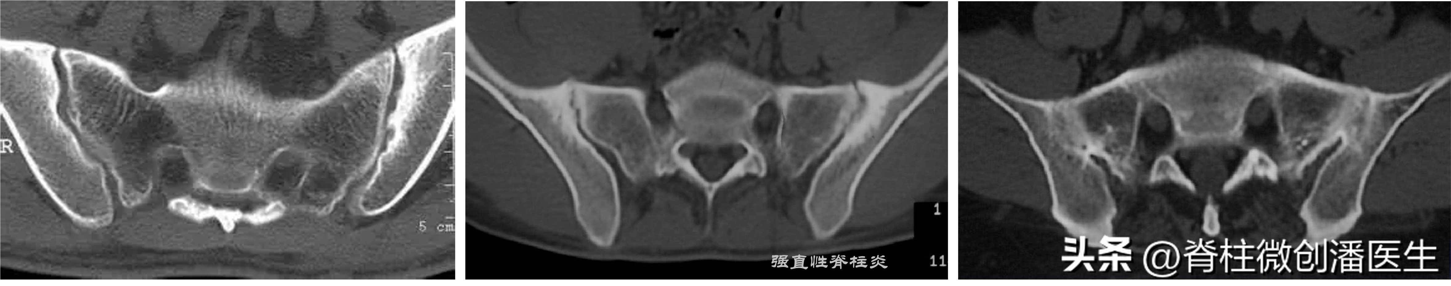 骶髂关节痛最好的锻炼方法,打喷嚏骶髂关节痛怎么回事