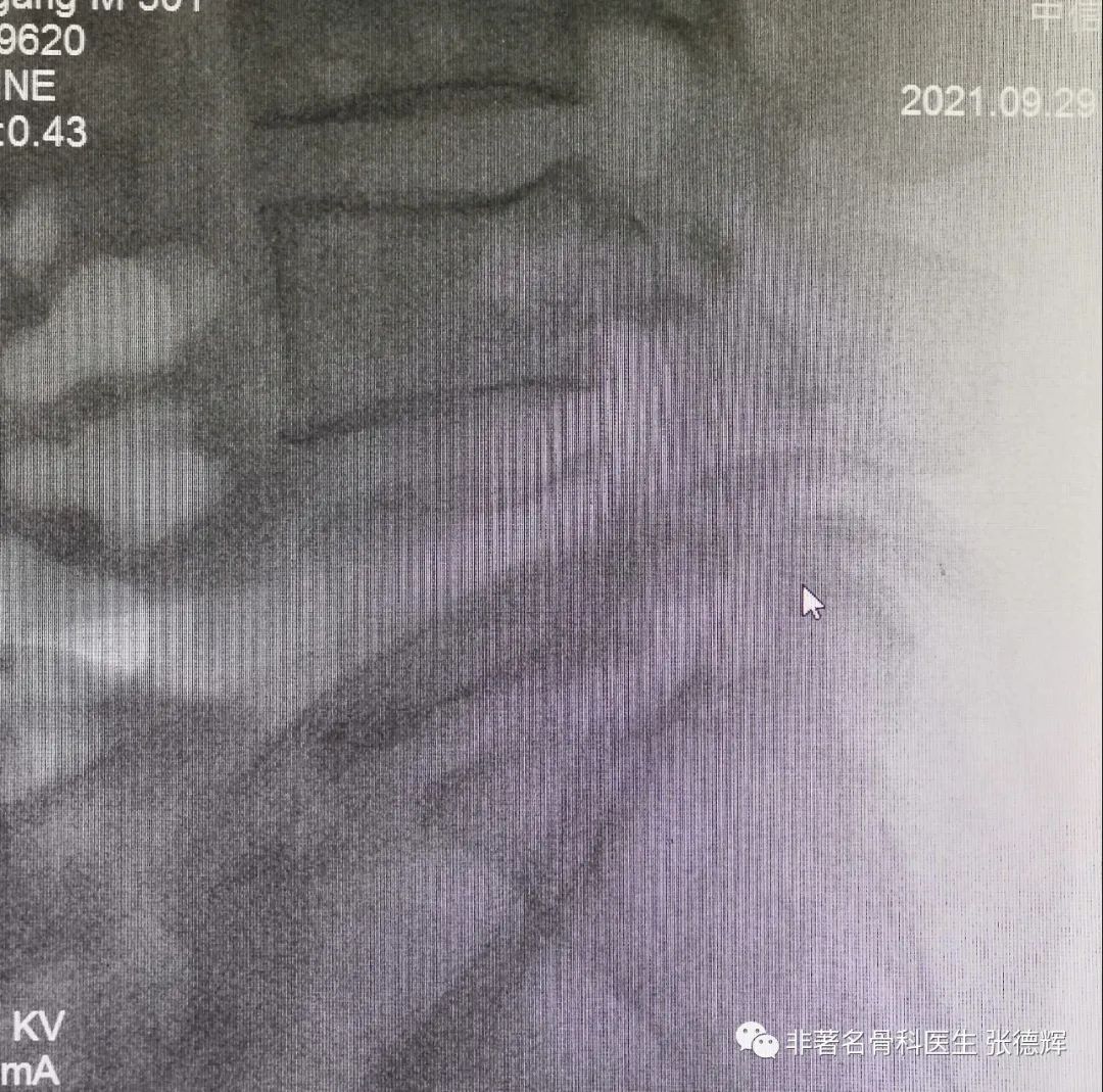 腰椎峡部裂的最好治疗方法,腰椎峡部裂