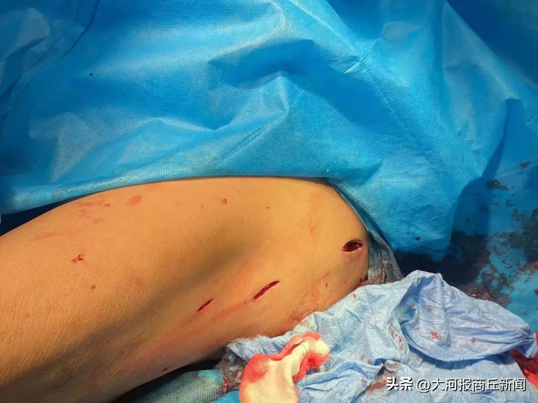 骨科医生腓骨骨折复位固定成功,骨科切开复位内固定