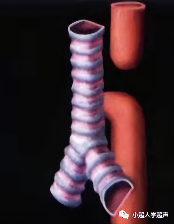 食道闭锁超声表现,食管闭锁一型手术过程