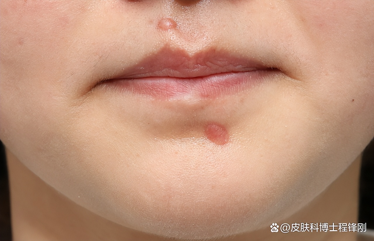 祛痣不长毛了,祛痣祛不掉