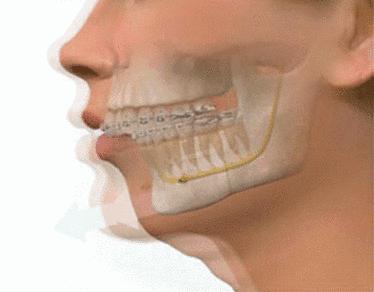 下巴后缩和下巴短怎么区分,下巴短小的原因