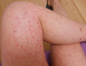 大腿根部顽固性紫癜,反复发作过敏性紫癜怎么治疗断根