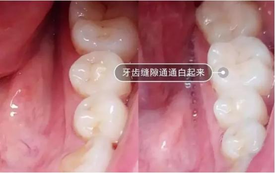 电动牙刷和普通牙刷对牙的好坏,不伤牙的电动牙刷