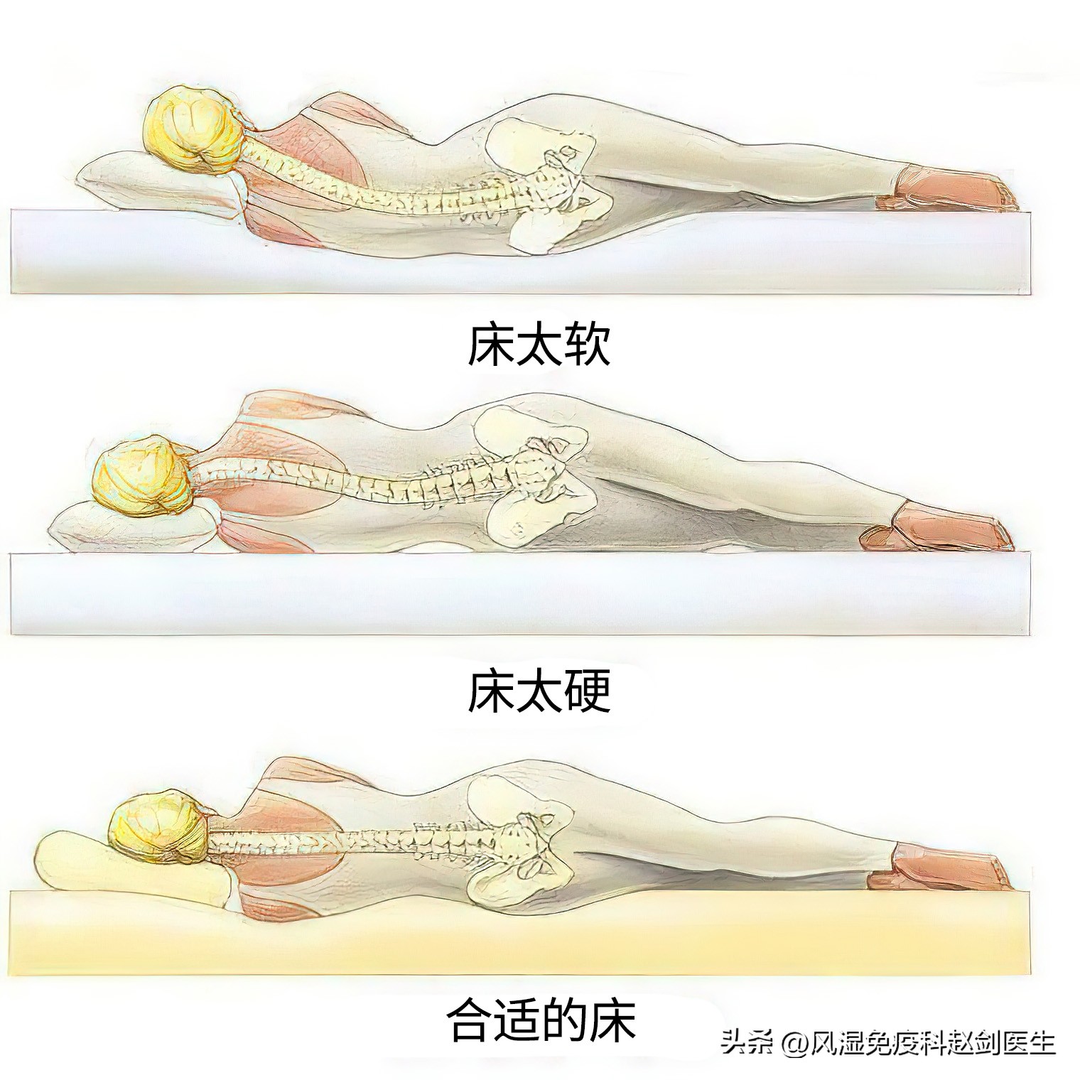 腰突马尾神经综合征发病率,坐骨神经跟马尾神经是一回事么