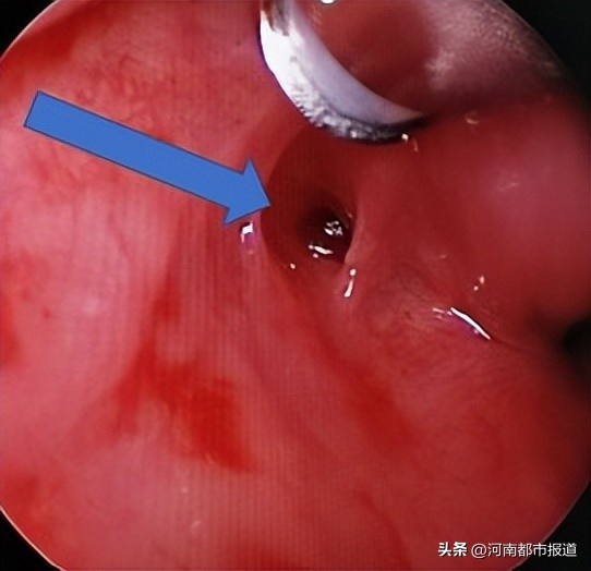 喉咙长了个小洞,喉咙里长了一个小泡要不要扎破